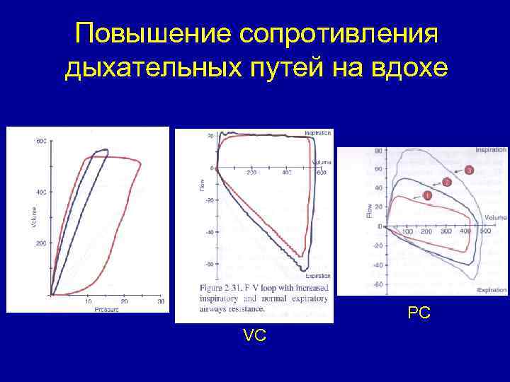 Повышение сопротивления дыхательных путей на вдохе PC VC 