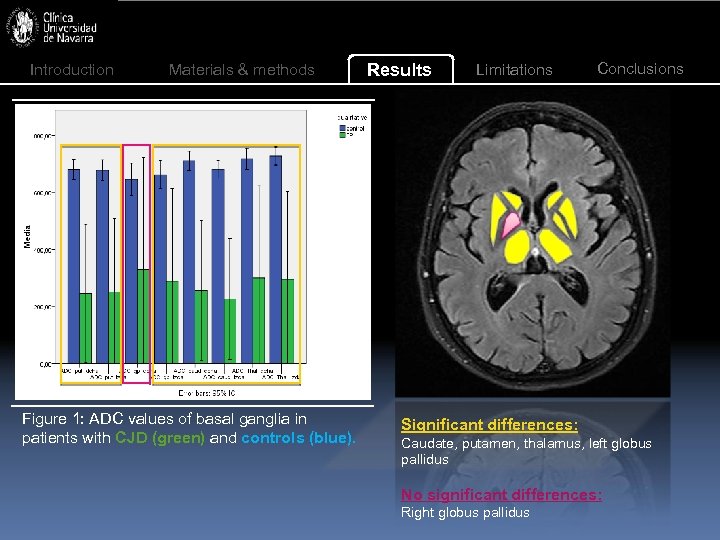 Introduction Materials & methods Figure 1: ADC values of basal ganglia in patients with