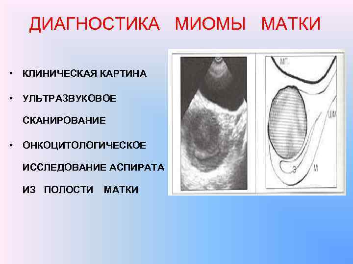 ДИАГНОСТИКА МИОМЫ МАТКИ • КЛИНИЧЕСКАЯ КАРТИНА • УЛЬТРАЗВУКОВОЕ СКАНИРОВАНИЕ • ОНКОЦИТОЛОГИЧЕСКОЕ ИССЛЕДОВАНИЕ АСПИРАТА ИЗ