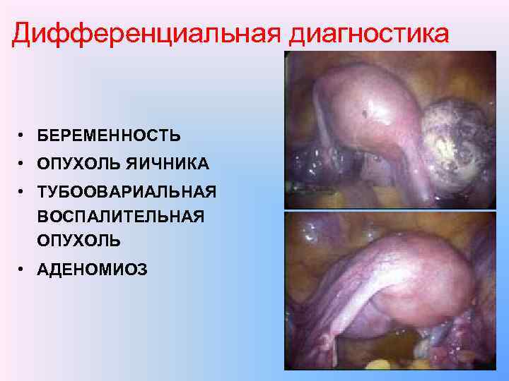 Дифференциальная диагностика • БЕРЕМЕННОСТЬ • ОПУХОЛЬ ЯИЧНИКА • ТУБООВАРИАЛЬНАЯ ВОСПАЛИТЕЛЬНАЯ ОПУХОЛЬ • АДЕНОМИОЗ 