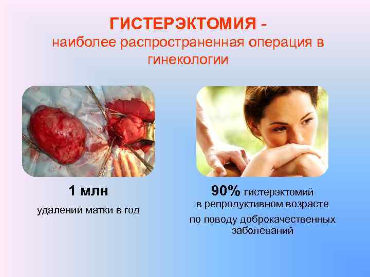 ГИСТЕРЭКТОМИЯ - наиболее распространенная операция в гинекологии 1 млн удалений матки в год 90%