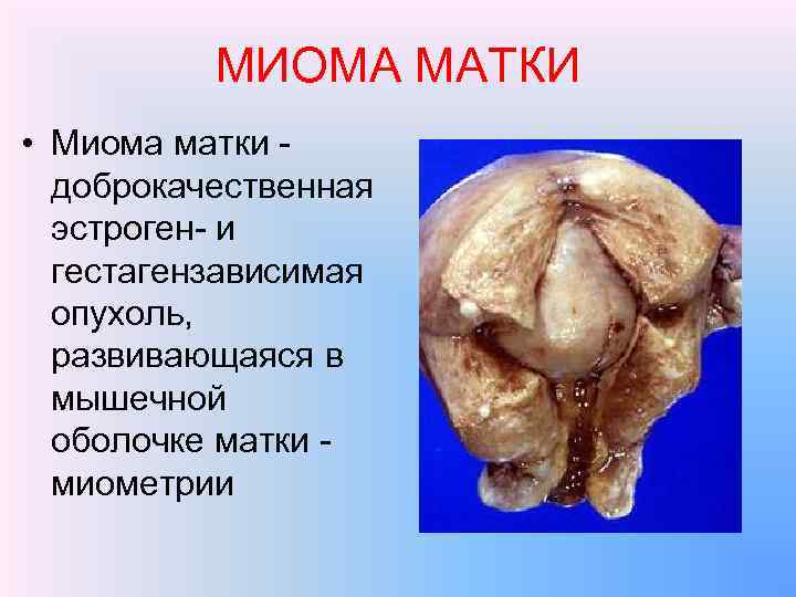МИОМА МАТКИ • Миома матки - доброкачественная эстроген- и гестагензависимая опухоль, развивающаяся в мышечной
