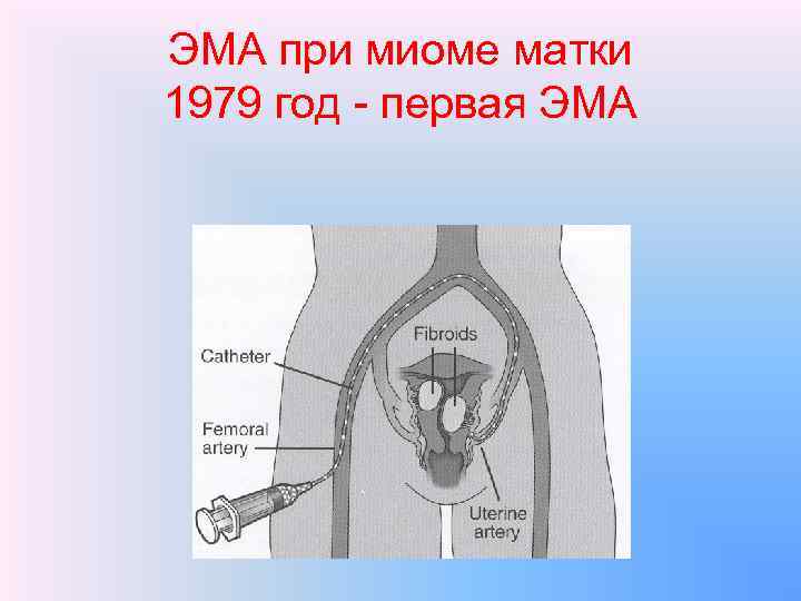 ЭМА при миоме матки 1979 год - первая ЭМА 
