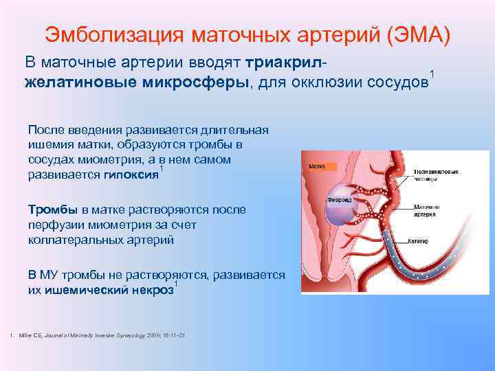 Эмболизация маточных артерий фото