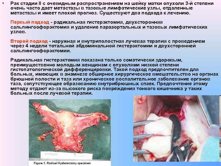  • Рак стадии II с очевидным распространением на шейку матки опухоли 3 -й