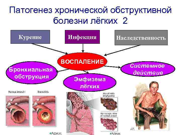 Хроническая обструктивная болезнь легких презентация