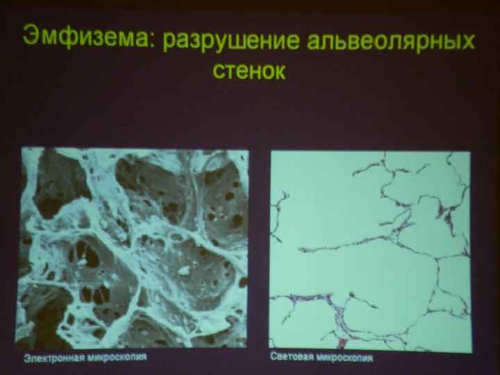 Хроническая лучевая болезнь картинки