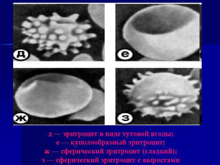 д — эритроцит в виде тутовой ягоды; е — куполообразный эритроцит; ж — сферический