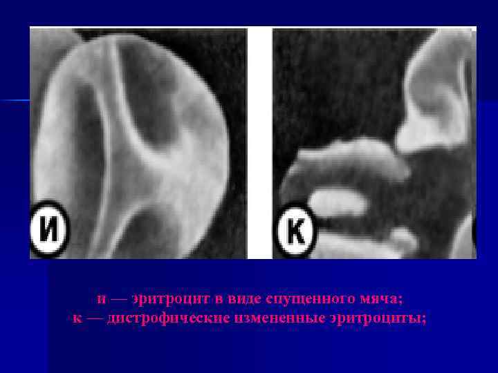 и — эритроцит в виде спущенного мяча; к — дистрофические измененные эритроциты; 