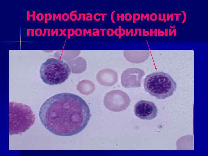 Нормобласты. Базофильный нормобласт. Оксифильный нормобласт. Оксифильный полихроматофильный нормобласт. Базофильный нормоцит.