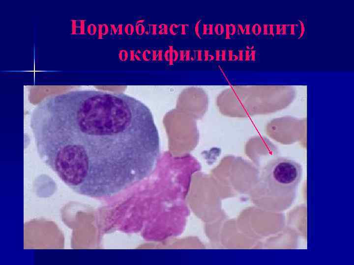 Нормобласты. Оксифильный полихроматофильный нормобласт. Оксифильный нормоцит в крови. Оксифильный нормоцит морфология. Оксифильнвц нормоюлась.