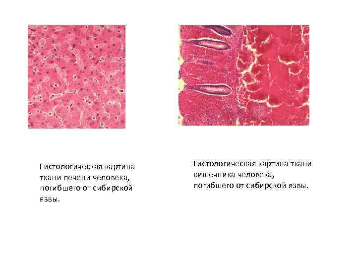 Гистологическая картина ткани печени человека, погибшего от сибирской язвы. Гистологическая картина ткани кишечника человека,