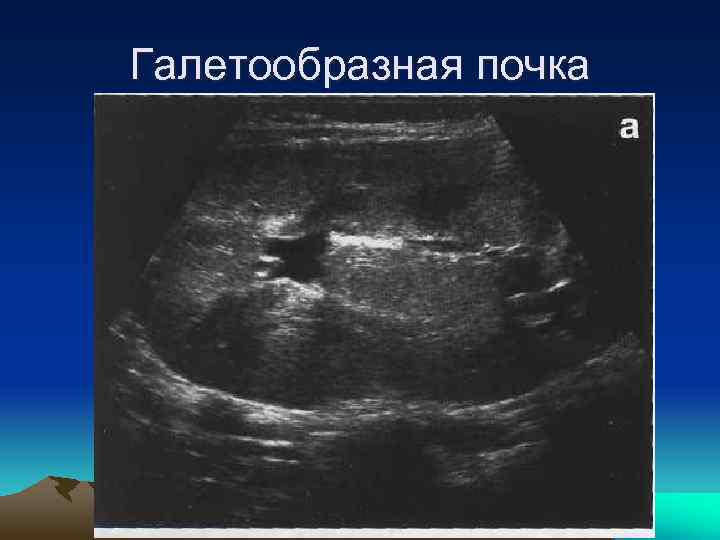 Галетообразная почка 