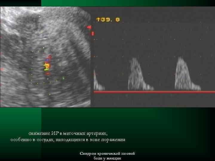 снижение ИР в маточных артериях, особенно в сосудах, находящихся в зоне поражения Синдром хронической