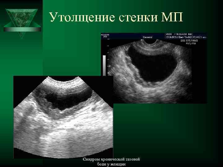 Утолщение стенки МП Синдром хронической тазовой боли у женщин 