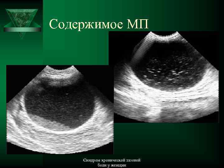 Содержимое МП Синдром хронической тазовой боли у женщин 