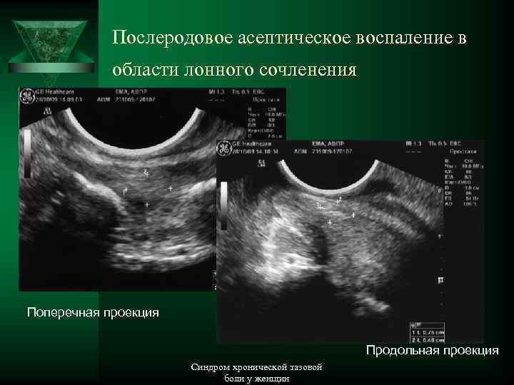 Послеродовое асептическое воспаление в области лонного сочленения Поперечная проекция Продольная проекция Синдром хронической тазовой