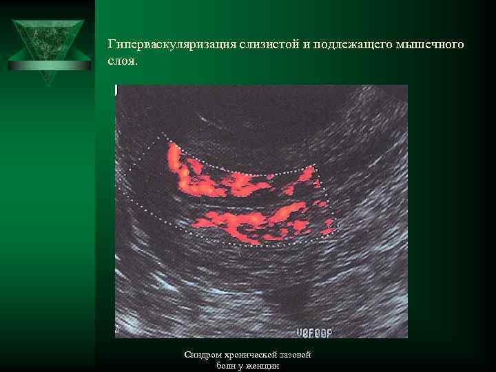 Гиперваскуляризация слизистой и подлежащего мышечного слоя. Синдром хронической тазовой боли у женщин 