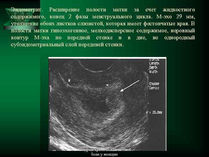 Эндометрит. Расширение полости матки за счет жидкостного содержимого, конец 2 фазы менструального цикла. М-эхо