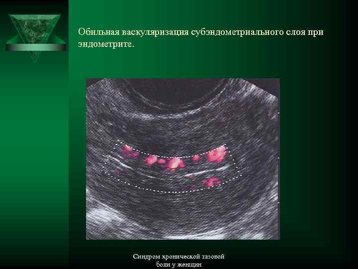 Эндометрий 23. Васкуляризация базального слоя эндометрия. Васкуляризация эндометрия матки. Васкуляризация эндометрия что это. Васкуляризация матки при УЗИ.