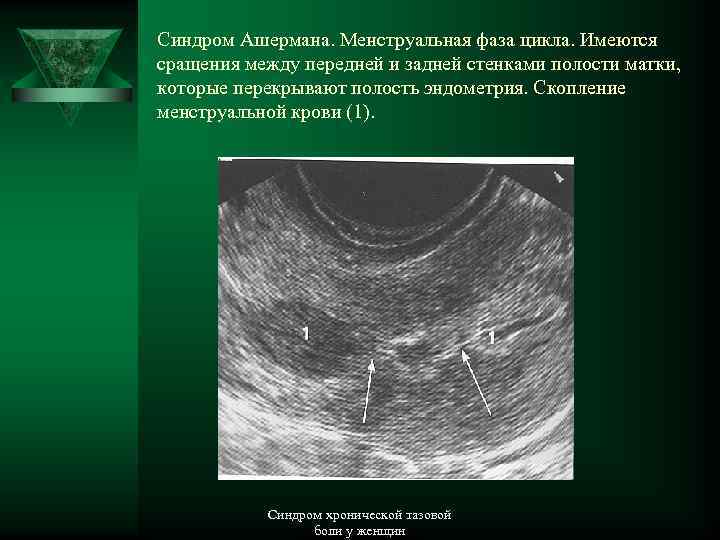 Синдром Ашермана. Менструальная фаза цикла. Имеются сращения между передней и задней стенками полости матки,