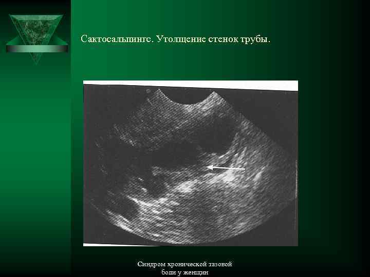 Сактосальпингс. Утолщение стенок трубы. Синдром хронической тазовой боли у женщин 