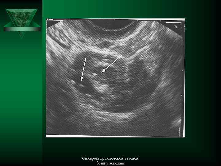 Тубоовариальное образование. Пузырьки газа. Синдром хронической тазовой боли у женщин 