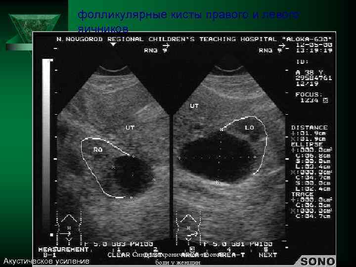 фолликулярные кисты правого и левого яичников Акустическое усиление Синдром хронической тазовой боли у женщин