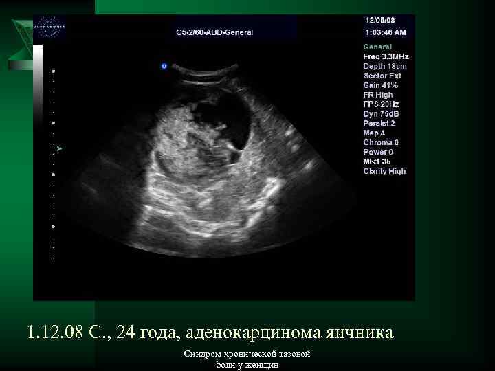 1. 12. 08 С. , 24 года, аденокарцинома яичника Синдром хронической тазовой боли у