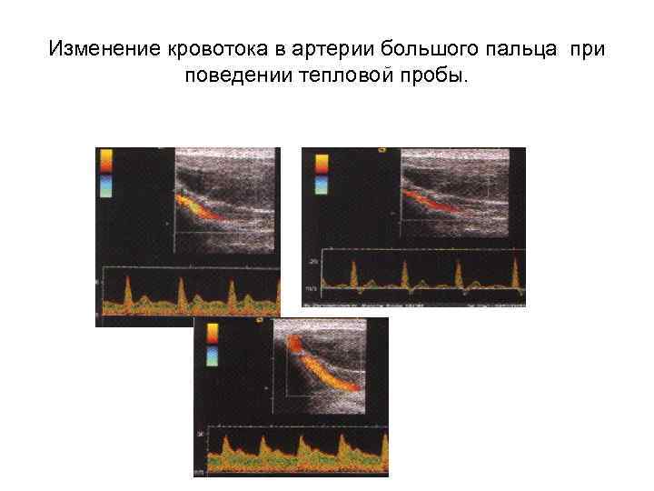 Изменение кровотока в артерии большого пальца при поведении тепловой пробы. 