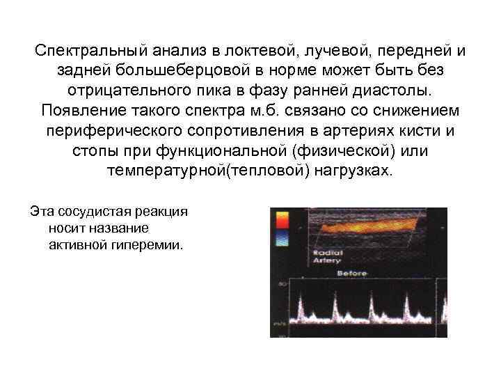 Спектральный анализ в локтевой, лучевой, передней и задней большеберцовой в норме может быть без