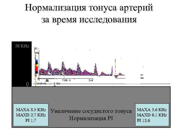 Нормализация тонуса артерий за время исследования 20 KHz 0 MAXA 8. 5 KHz MAXD