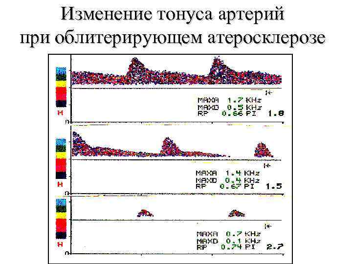 Изменение тонуса артерий при облитерирующем атеросклерозе 