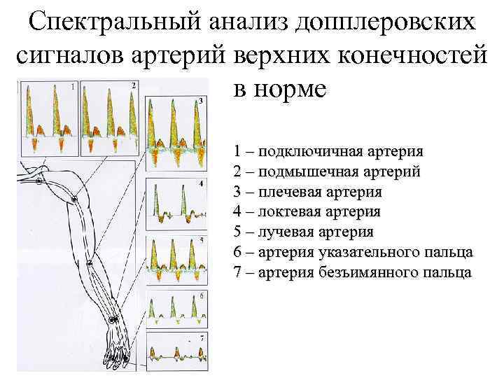 Спектральный анализ допплеровских сигналов артерий верхних конечностей в норме 1 – подключичная артерия 2