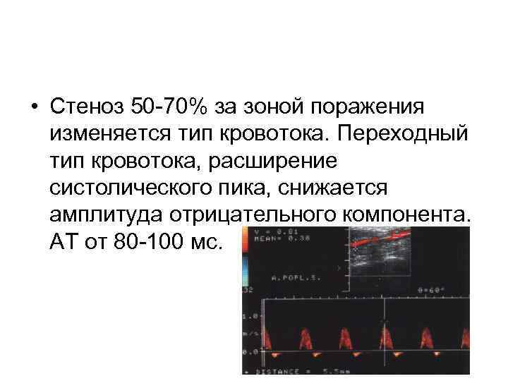  • Стеноз 50 -70% за зоной поражения изменяется тип кровотока. Переходный тип кровотока,