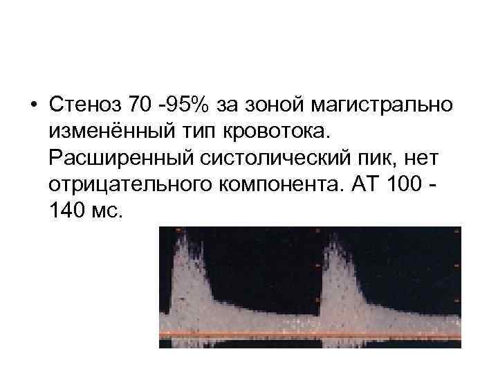  • Стеноз 70 -95% за зоной магистрально изменённый тип кровотока. Расширенный систолический пик,