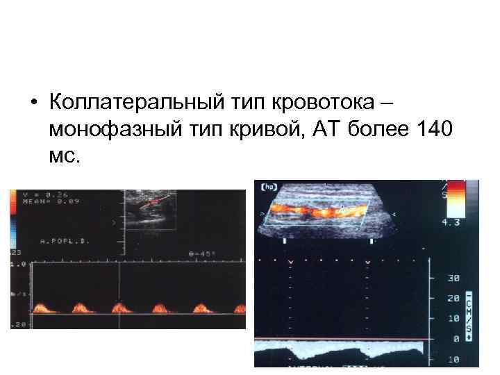  • Коллатеральный тип кровотока – монофазный тип кривой, АТ более 140 мс. 