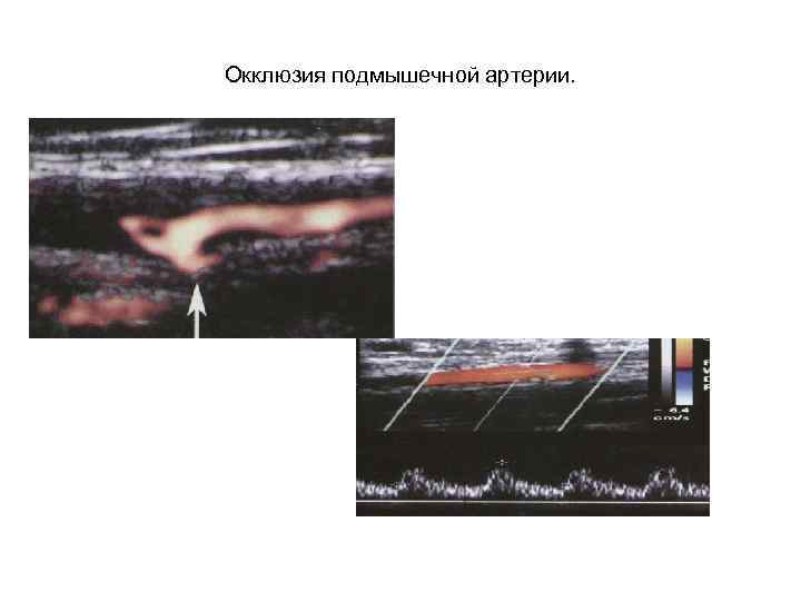 Окклюзия подмышечной артерии. 