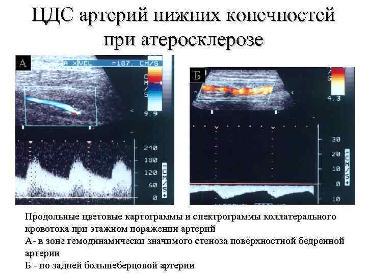 Цдс мониторинг расписание. Магистрально измененный кровоток в артериях нижних конечностей. Коллатеральный кровоток в артериях нижних конечностей. Магистрально измененный кровоток по УЗИ. Магистральный измененный кровоток на УЗИ.