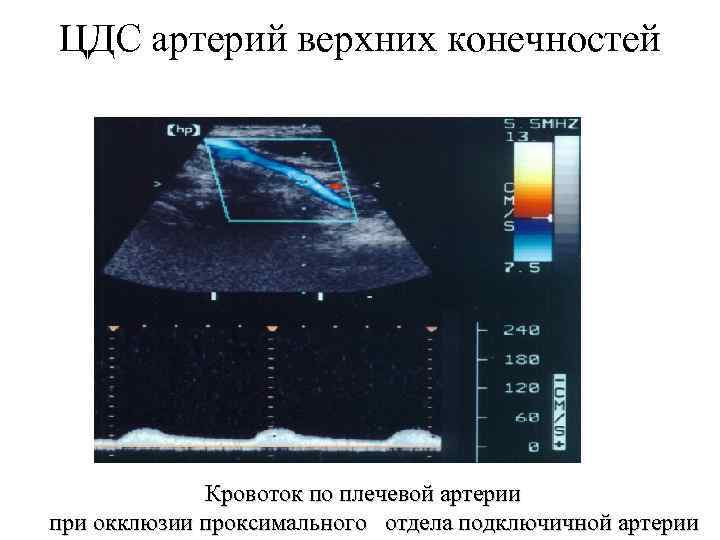 ЦДС артерий верхних конечностей Кровоток по плечевой артерии при окклюзии проксимального отдела подключичной артерии