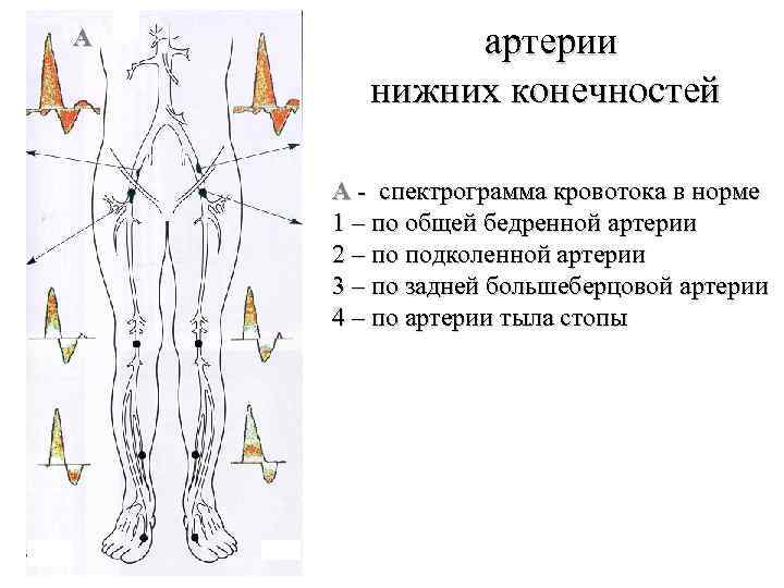 А артерии нижних конечностей А - спектрограмма кровотока в норме 1 – по общей