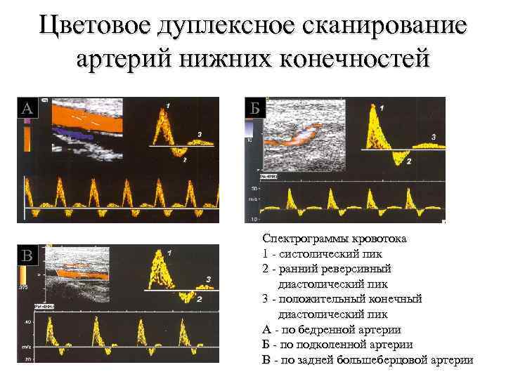 Нижнее сканирование. Цветовое дуплексное сканирование артерий нижних конечностей. Дуплекс сканирование артерий нижних конечностей. Дуплексное сканирование артерий нижних конечностей расшифровка. Дуплексное сканирование артерий нижних конечностей норма.