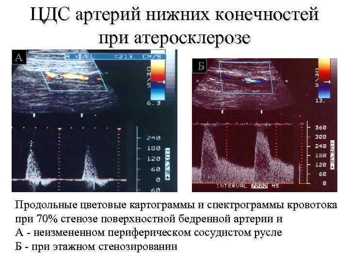 ЦДС артерий нижних конечностей при атеросклерозе А Б Продольные цветовые картограммы и спектрограммы кровотока