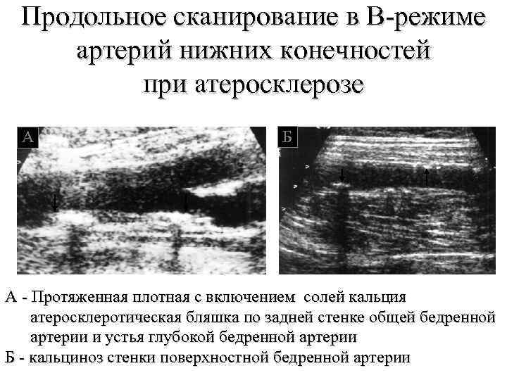 Продольное сканирование в В-режиме артерий нижних конечностей при атеросклерозе А А А Б А