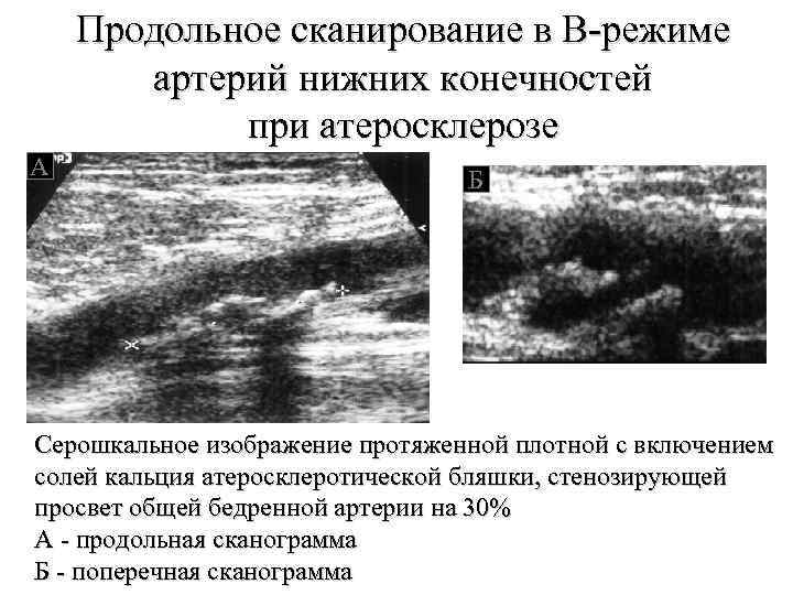 Продольное сканирование в В-режиме артерий нижних конечностей при атеросклерозе А Б Серошкальное изображение протяженной