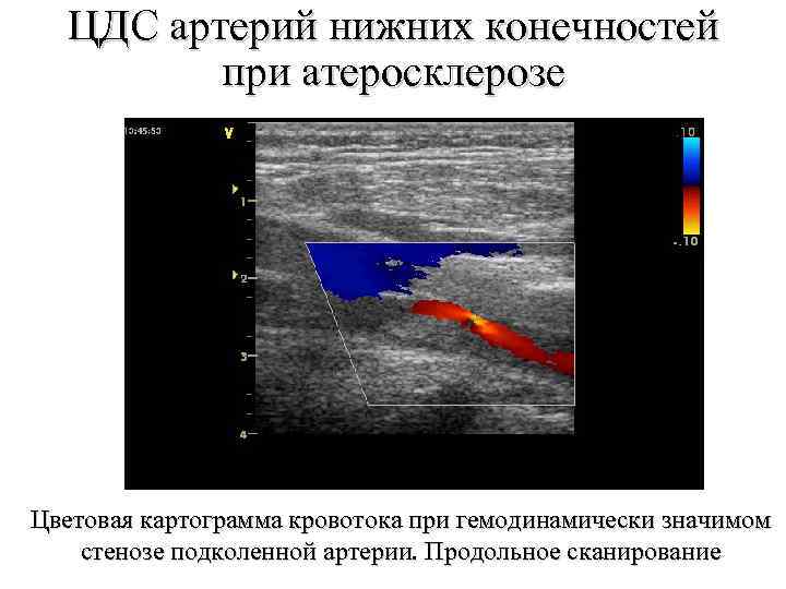 Узи атеросклероз. УЗИ критерии стеноза артерий нижних конечностей. УЗИ артерий нижних конечностей протокол. УЗИ заключение атеросклероз артерий нижних конечностей. УЗИ артерий нижних конечностей протокол атеросклероз.