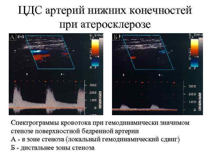 ЦДС артерий нижних конечностей при атеросклерозе А Б Спектрограммы кровотока при гемодинамически значимом стенозе