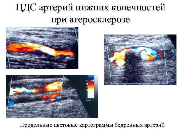 ЦДС артерий нижних конечностей при атеросклерозе Продольные цветовые картограммы бедренных артерий 