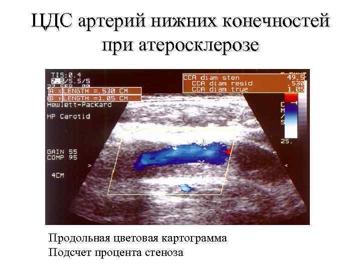 ЦДС артерий нижних конечностей при атеросклерозе Продольная цветовая картограмма Подсчет процента стеноза 