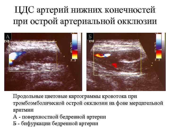 ЦДС артерий нижних конечностей при острой артериальной окклюзии А Б Продольные цветовые картограммы кровотока